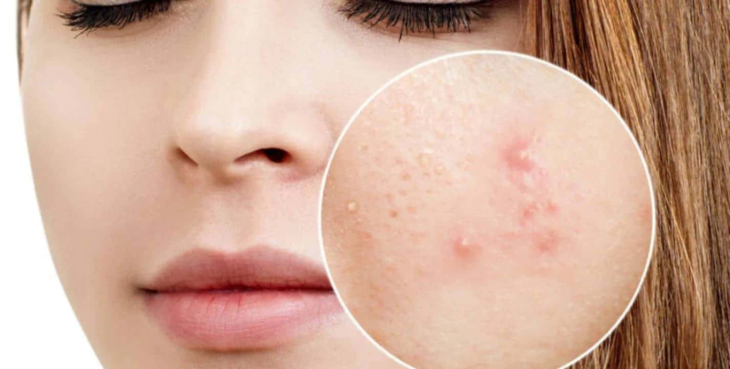 Como remover acne e manchas na pele usando tomate e aveia