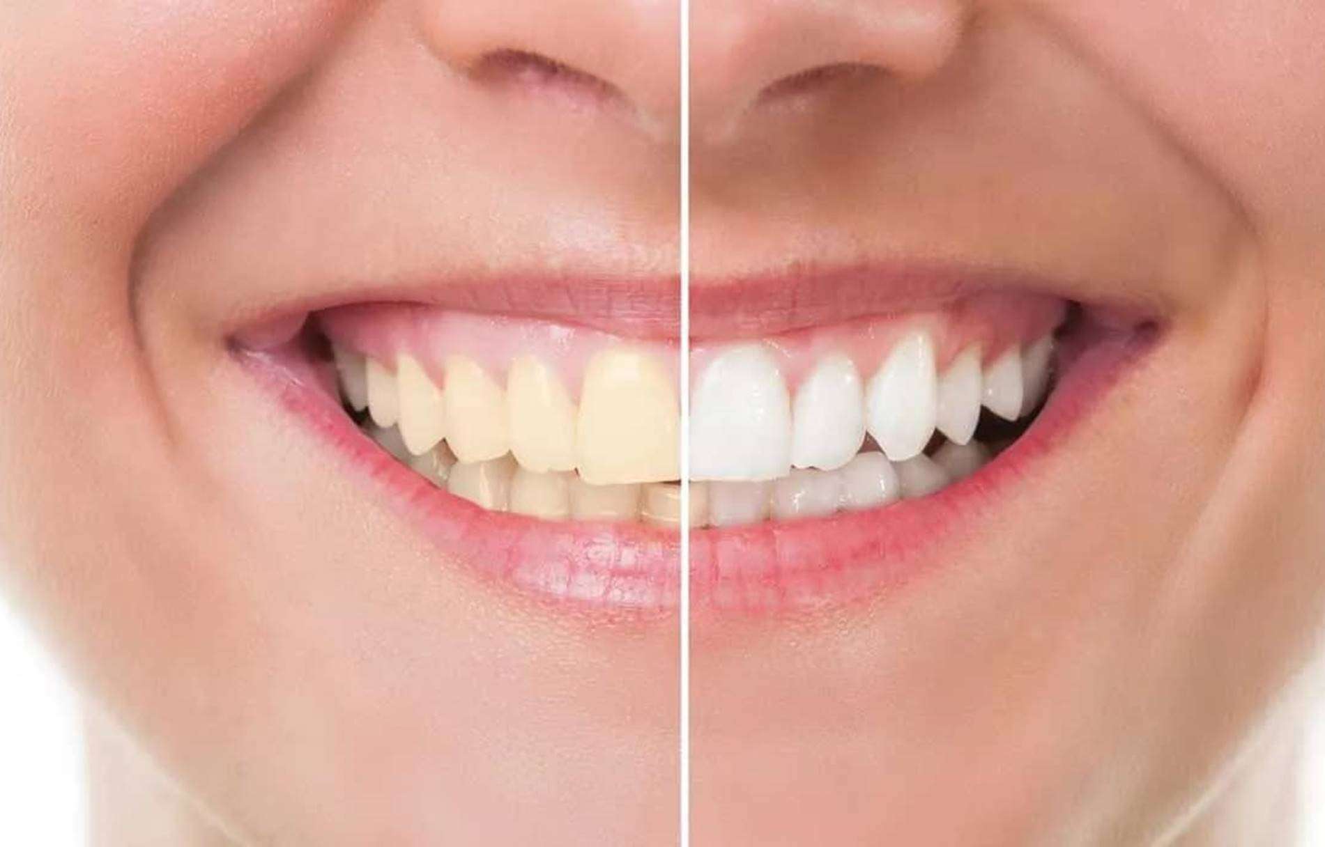 Como clarear dentes sensíveis naturalmente em casa