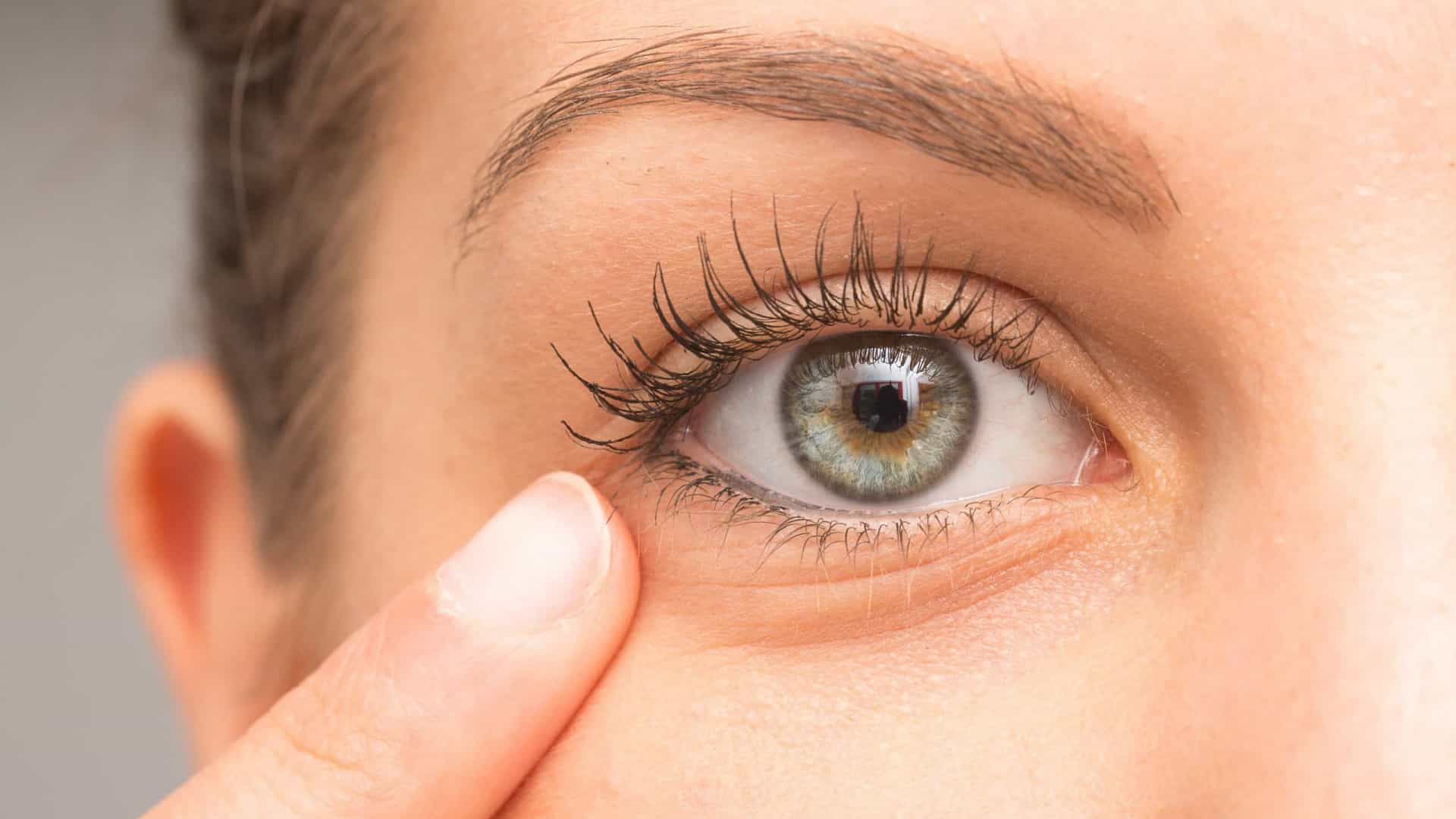 Bolsas sob os olhos: remédios naturais para remover olheiras
