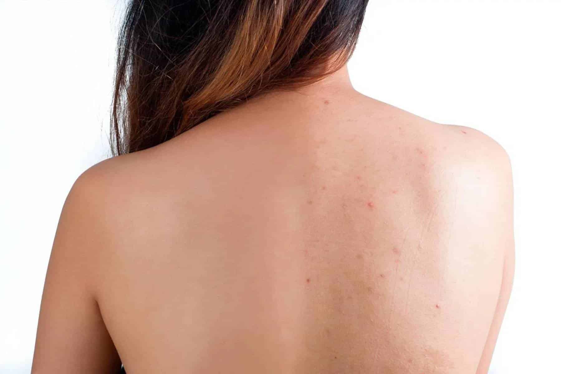 Conheça os motivos que fazem a acne aparecer nas costas e como tratá-la