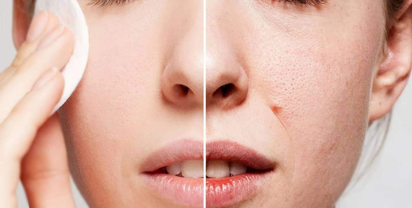 Segredo coreano: remova manchas e impurezas do rosto com tônico natural