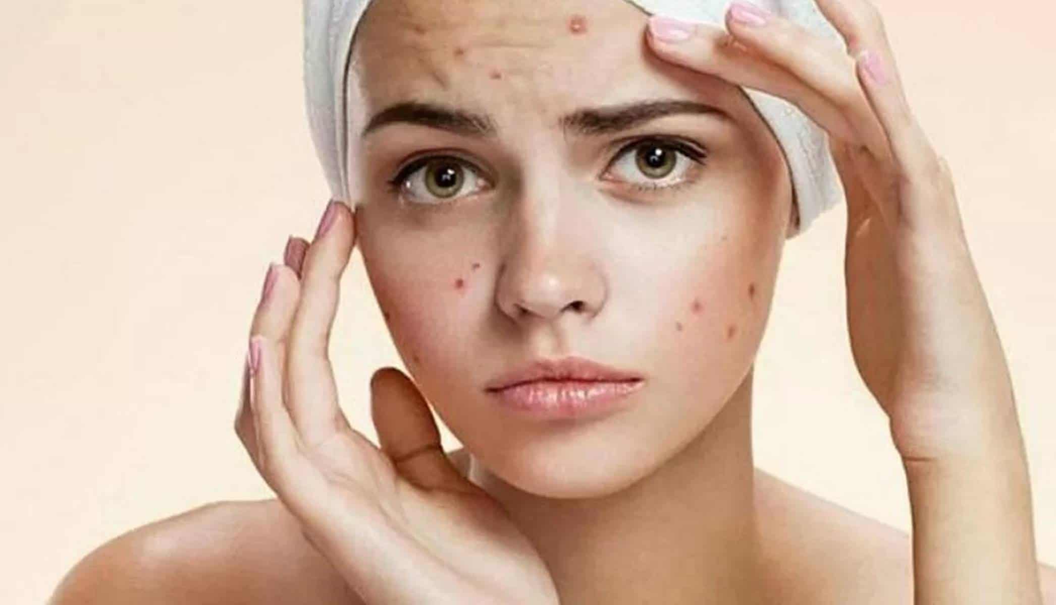 Nunca mais terá acne se usar esses 3 ingredientes caseiros eficazes
