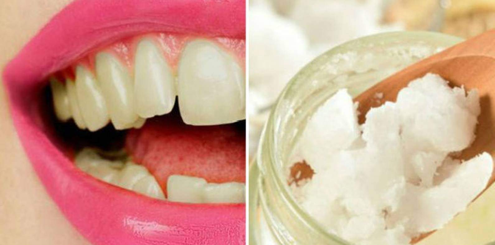 Descubra a maneira correta de clarear os dentes com óleo de coco