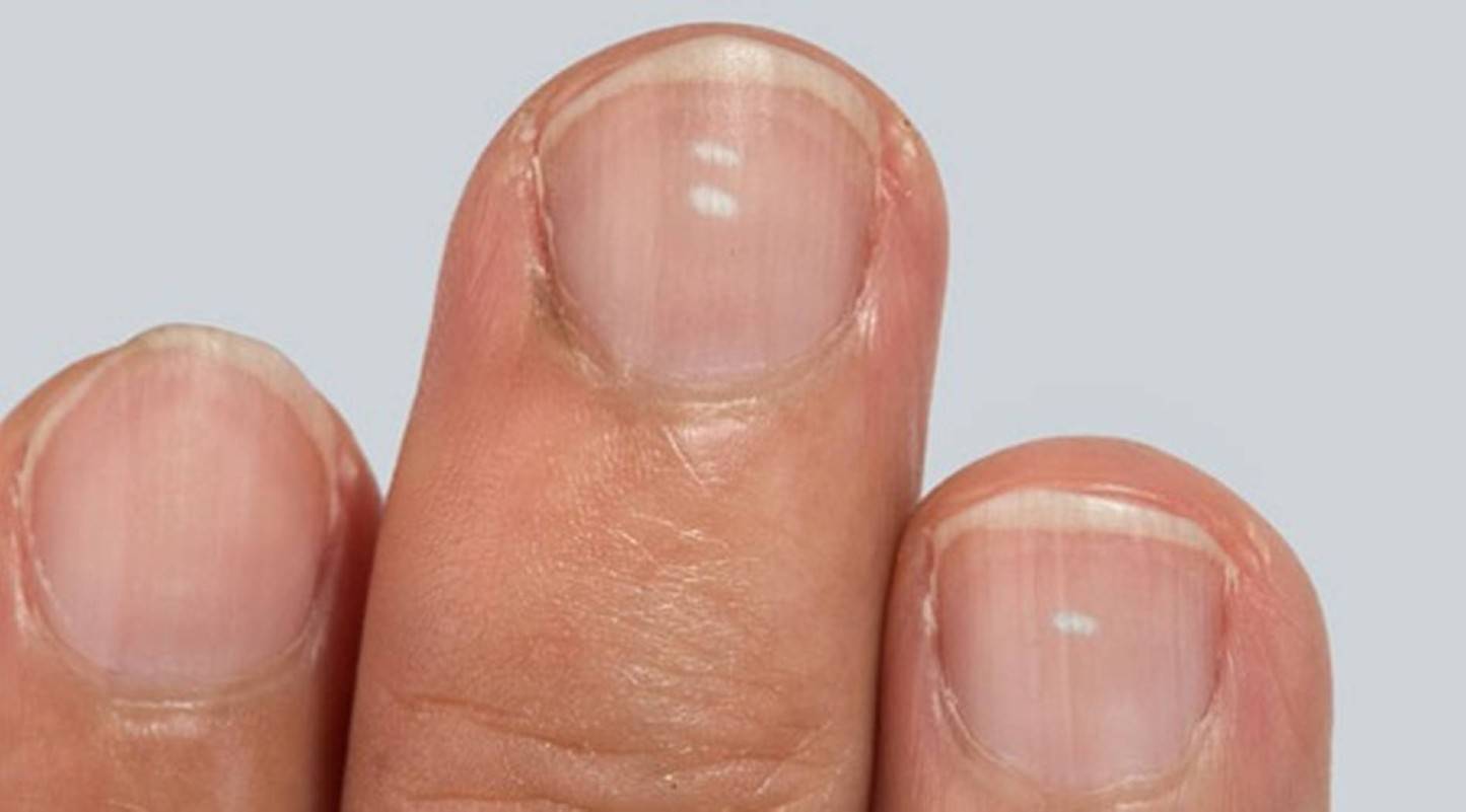 O que significam as manchas brancas nas unhas e quando você deve se preocupar?